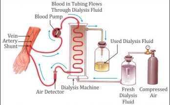 ﻿What is Dialysis or Haemodialysis