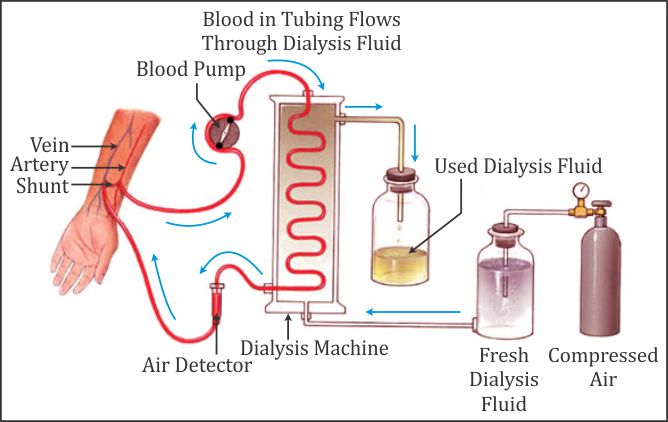 What Happens If Someone Misses A Dialysis For Two Days