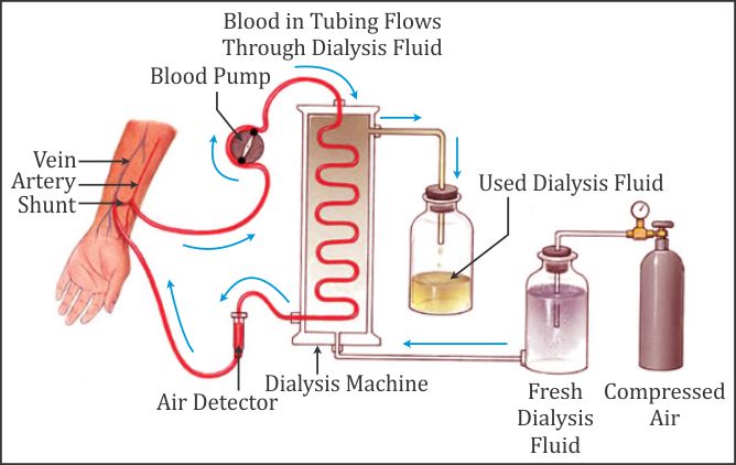 What Is The Process Of Dialysis In Chemistry