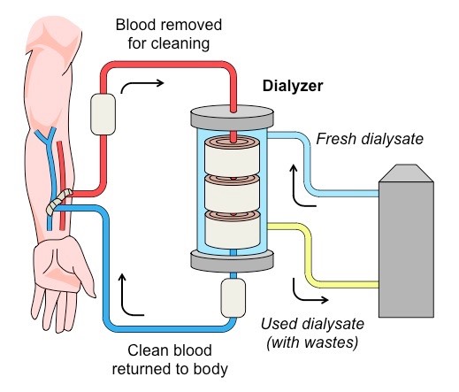 Does Dialysis Remove Fluid From The Lungs